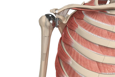 Shoulder Joint Replacement