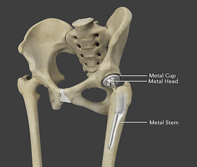 Total Hip Replacement