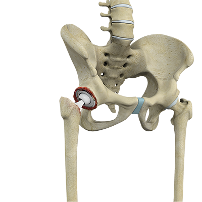 Revision Hip Replacement