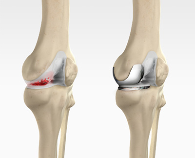 Unicondylar (Unicompartmental) Knee Replacement